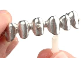 Toronto Implant Bridge cemented on the Integral Castable Abutments